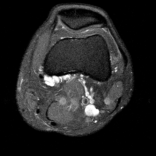 MRI axial left knee (4): the cysts grow & appear to be around the origin of the medial gastroc