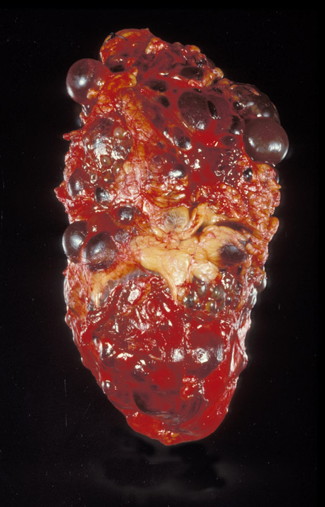 Polycystic kidney.