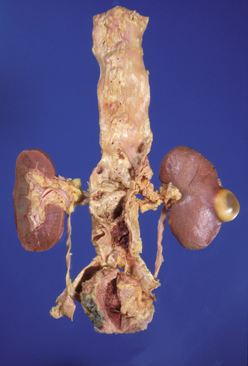 Esophagus, kidneys(cyst), bladder.