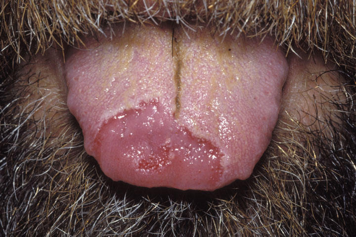 Burned skin on tongue.