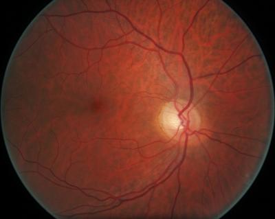 Normal Retina