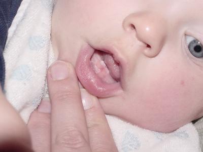 1st Two Teeth - Oct 2002