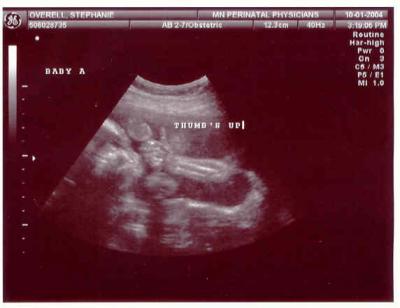 Baby A Thumbs Up 23 wks
