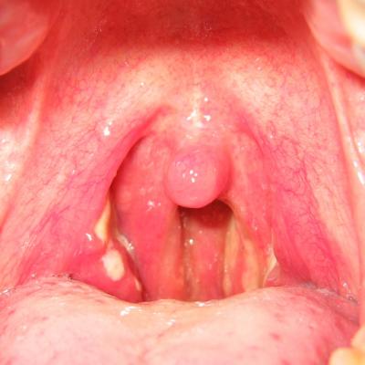 Streptococcal off center of the uvula