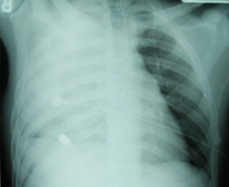 GSW Right Chest with hemothorax