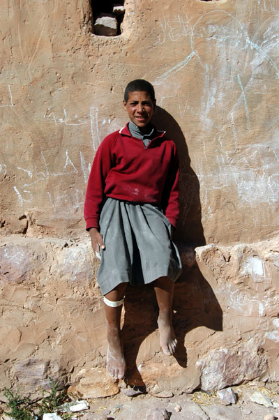 Boy with an injured leg in Kawkaban
