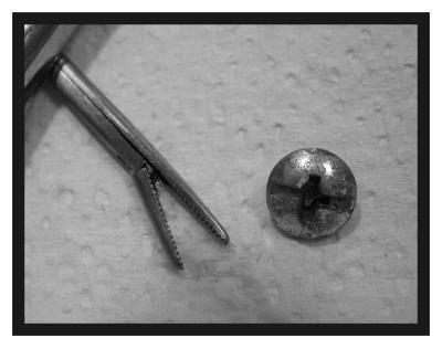 Screw-head rescued from nose