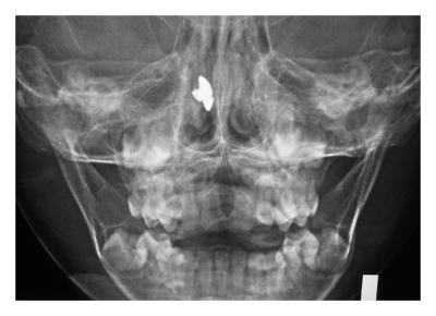 Screw-head rescued from nose X-ray