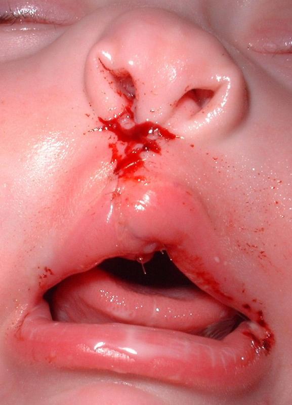 POST OPT CLOSE UP STITCHES