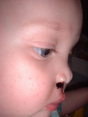 If I would stop hitting my nose with my toys the bleeding would of stopped quicker.