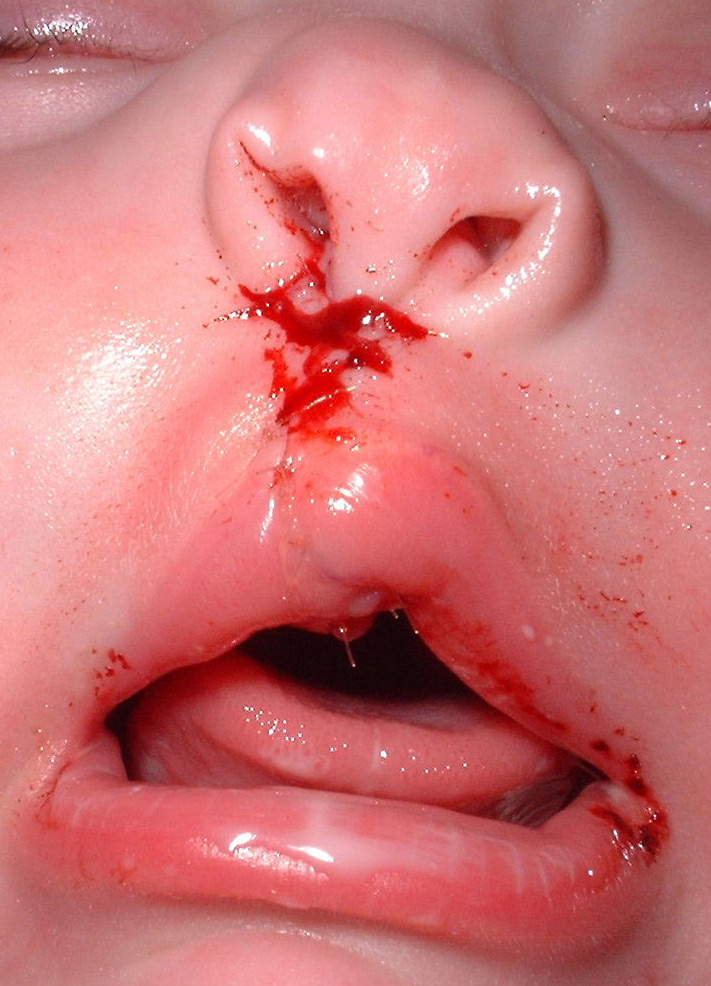POST OPT CLOSE UP STITCHES