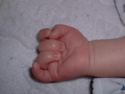 Max's hand June 10th.jpg