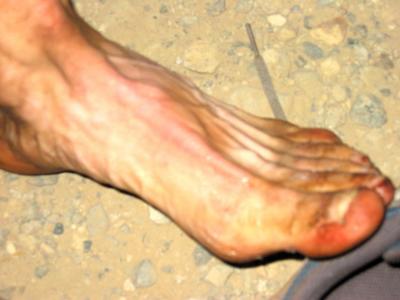 Mike Moser's foot