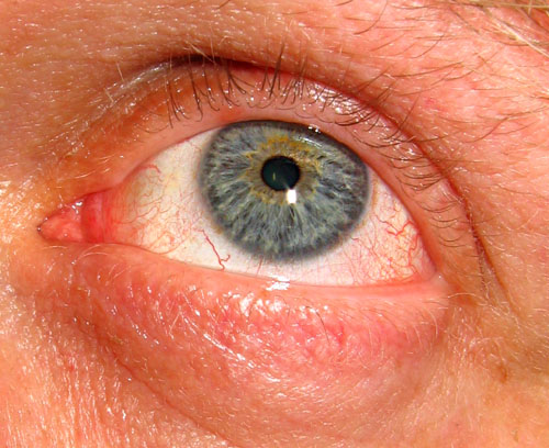 Eye The window to the Soul*