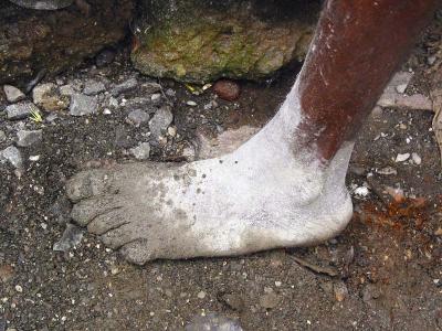 cement worker's foot