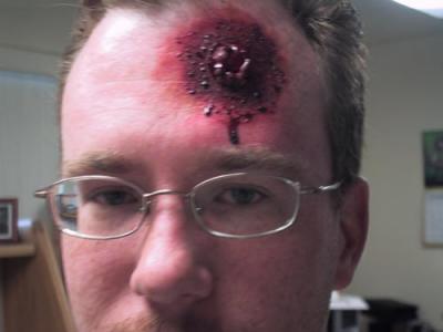 Jeff's bullet wound 2.jpg