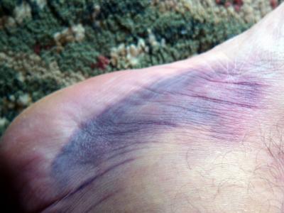 Ouch (Mar 3rd)