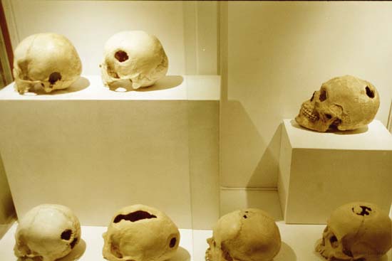 Skulls that had brain surgery, Museo Inka, Cusco
