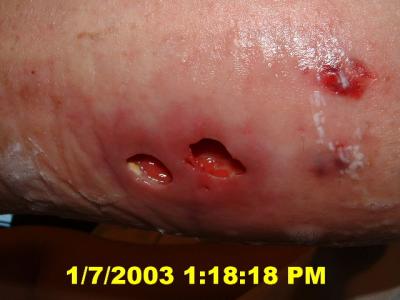 calf wound 6