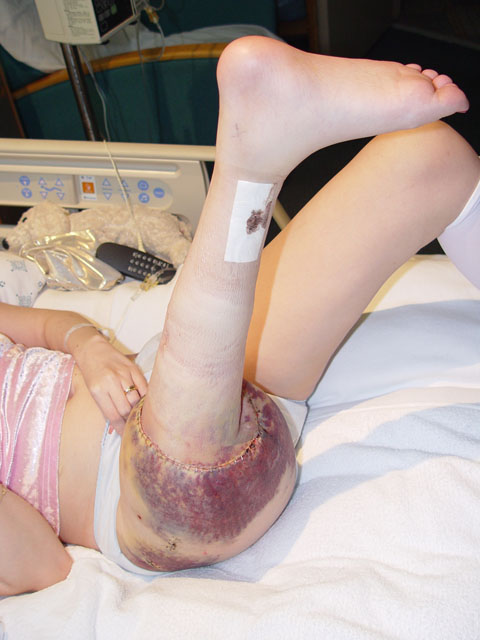 theres a pin in my ankle!