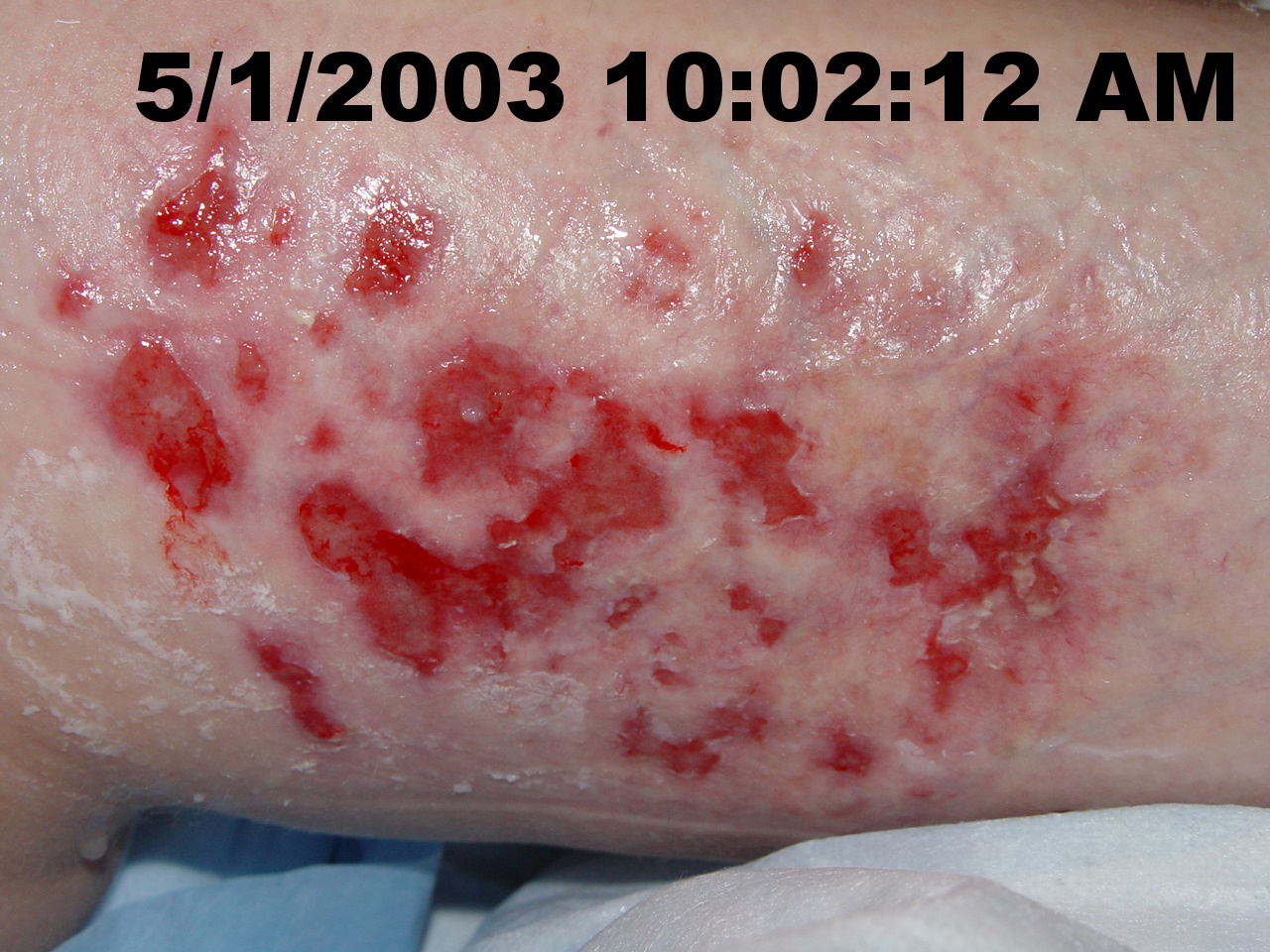 back of thigh 11