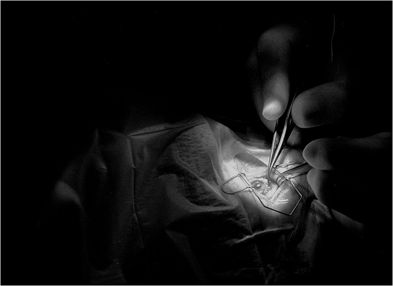 Cataract Surgery