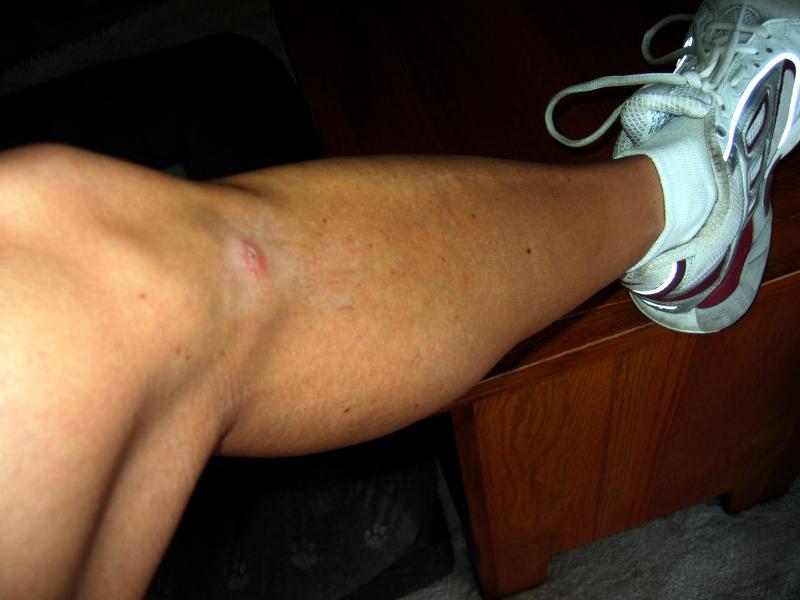 3 weeks post-op:  note the running shoes! (but also the lingering medial thigh atrophy)