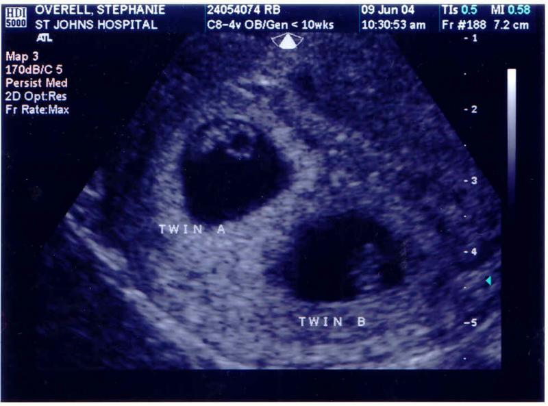 Twins 7 week ultrasound Monochorionic diamniotic