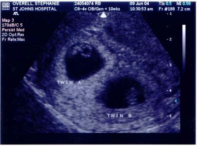 Twins 7 Week Ultrasound