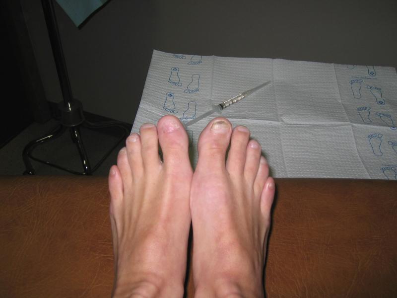 The left one was permanently removed 2 months earlier with excellent results.
