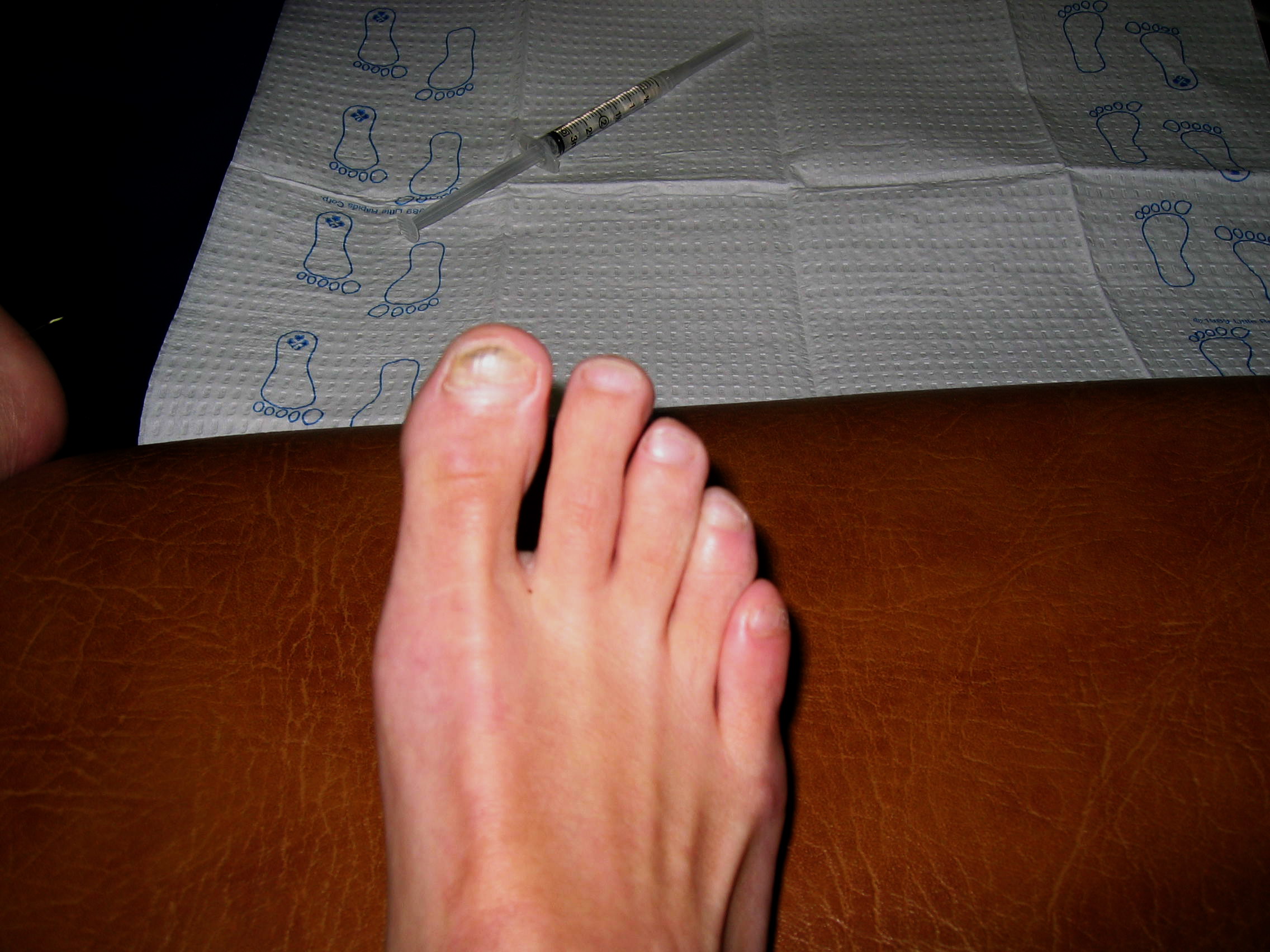 Ingrown and painful. Ive had to have the big toenail removed twice in the past.  This time its for good!
