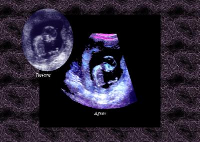 u43/sonoart/medium/34346735.beforeaandafterkeri4gall.jpg