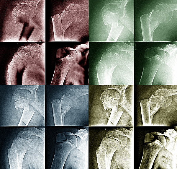 <b>Shoulder Series</b><br>by johnebones