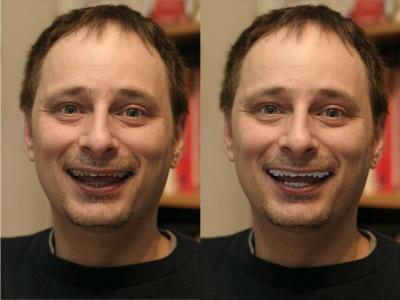 Braces Removed