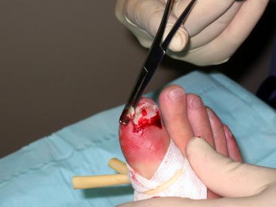 removal and debridement