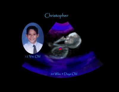 Chris at 20 wks. gestational age