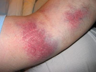 Bruise - day1 (872)