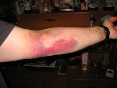 Bruise - day2 (585)