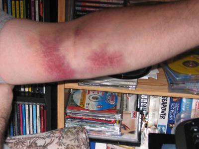 Bruise - day1 (784)