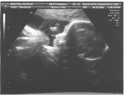Ultrasound showing the profile of the new baby (legs curled up to the stomach on the left, head on the right)