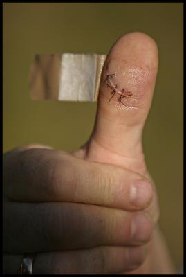 Wound