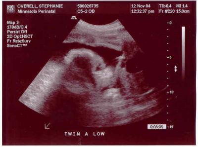 Twin A 29 Weeks Face