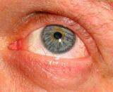 Eye The window to the Soul*