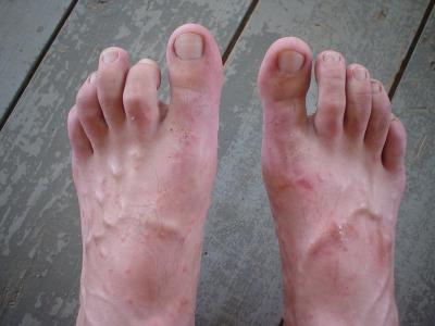 the sandflies are the bane of Utila