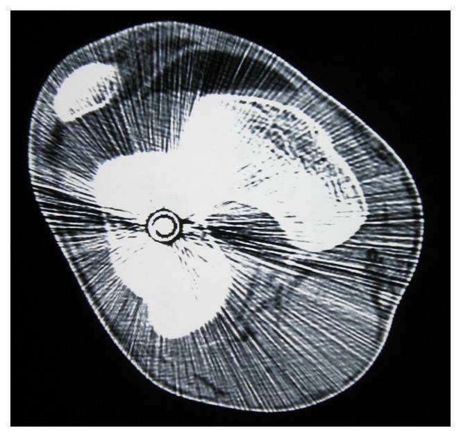 Bullet in Knee on CT