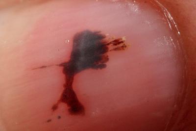 Painful Fingernail *