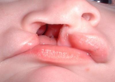Cleft lip and cleft palate can occur on one side (unilateral cleft lip and/or palate), or on both sides (bilateral cleft lip and/or palate). Because the lip and the palate develop separately, it is possible for the child to have a cleft lip, a cleft palate, or both cleft lip and cleft palate