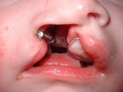 The Latham device is not visible from the outside of your child's mouth. You can see the plastic and metal device when the child opens his mouth or yawns.The device is attached to the roof of the child's mouth in the operating room under general anesthesia.

