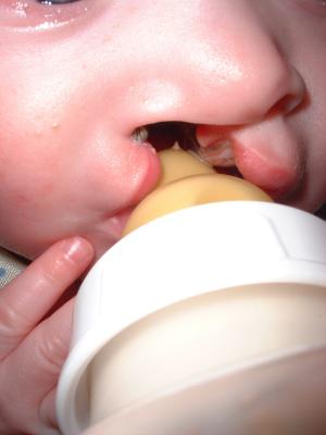 Your baby may not get enough to eat, or may get too tired when eating. Sometimes babies have problems with food coming out of the nose. The baby may choke, cough, and spit.