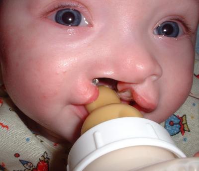 The goal of feeding your baby is to lessen these problems and ensure good weight gain. Follow feedings with little bit of water to cleanse the inside of the mouth. If you notice formula sitting in the babys mouth, you can use a bulb syringe to remove it, or gently wipe it away with a piece of gauze.

